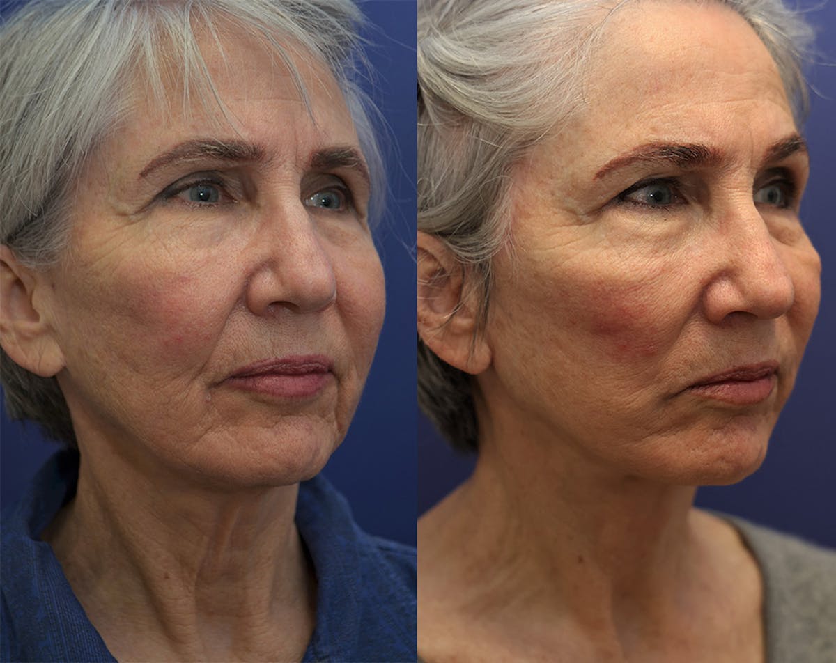 Deep Plane Facelift Before & After Gallery - Patient 348350 - Image 4