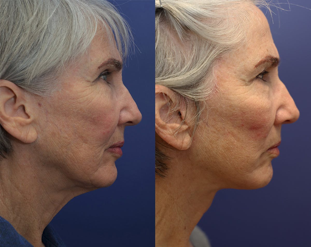 Deep Plane Facelift Before & After Gallery - Patient 348350 - Image 5