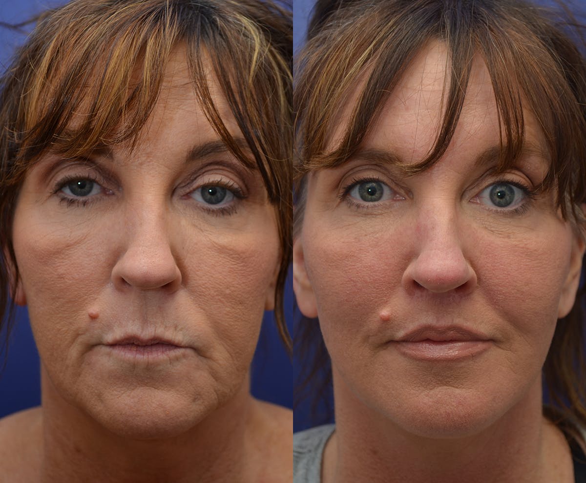 Deep Plane Facelift Before & After Gallery - Patient 121088 - Image 1