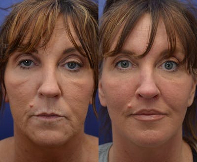 Full Facial Rejuvenation Before & After Gallery - Patient 189155 - Image 1