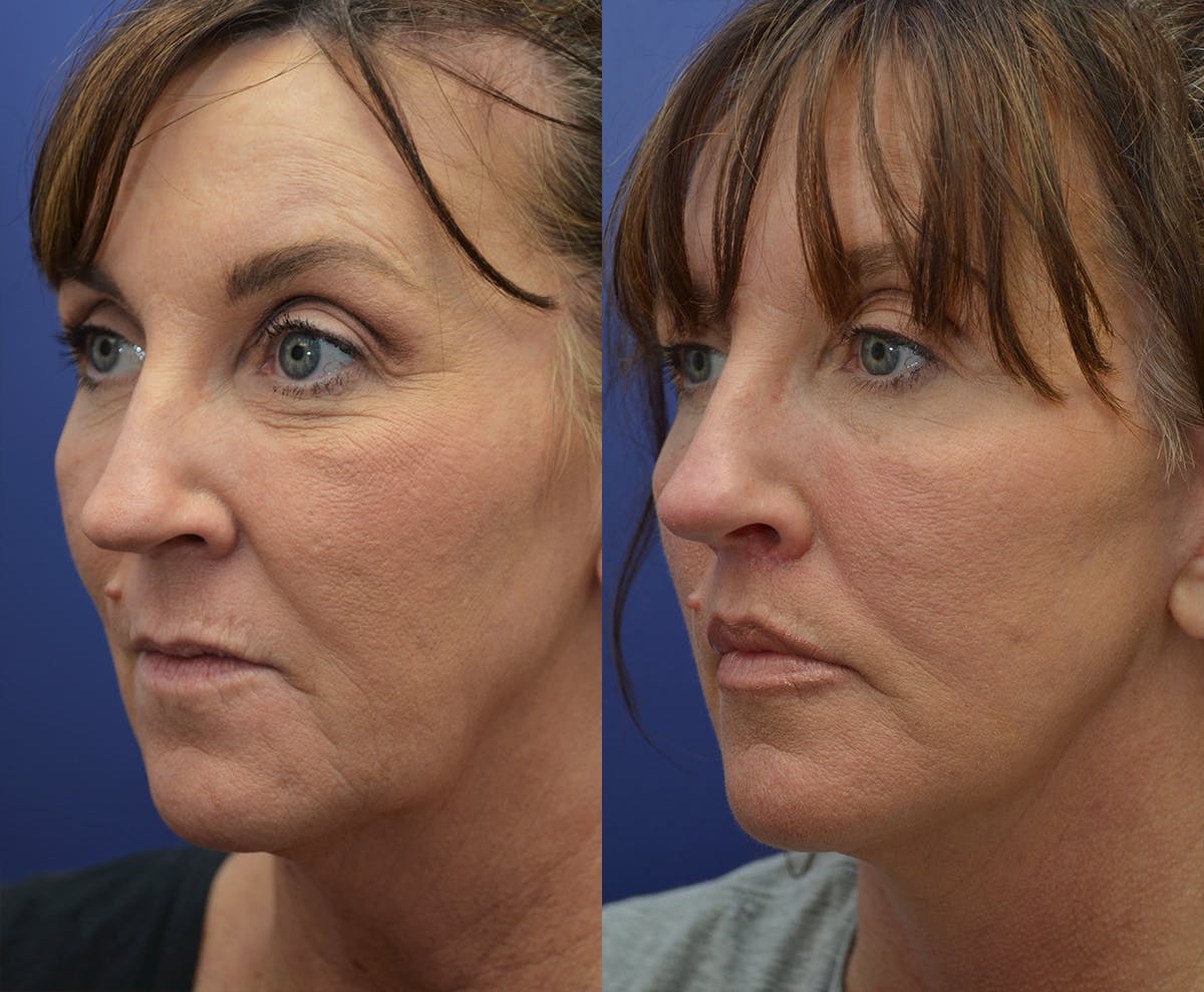 Deep Plane Facelift Before & After Gallery - Patient 121088 - Image 2