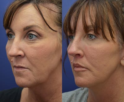 Full Facial Rejuvenation Before & After Gallery - Patient 189155 - Image 2