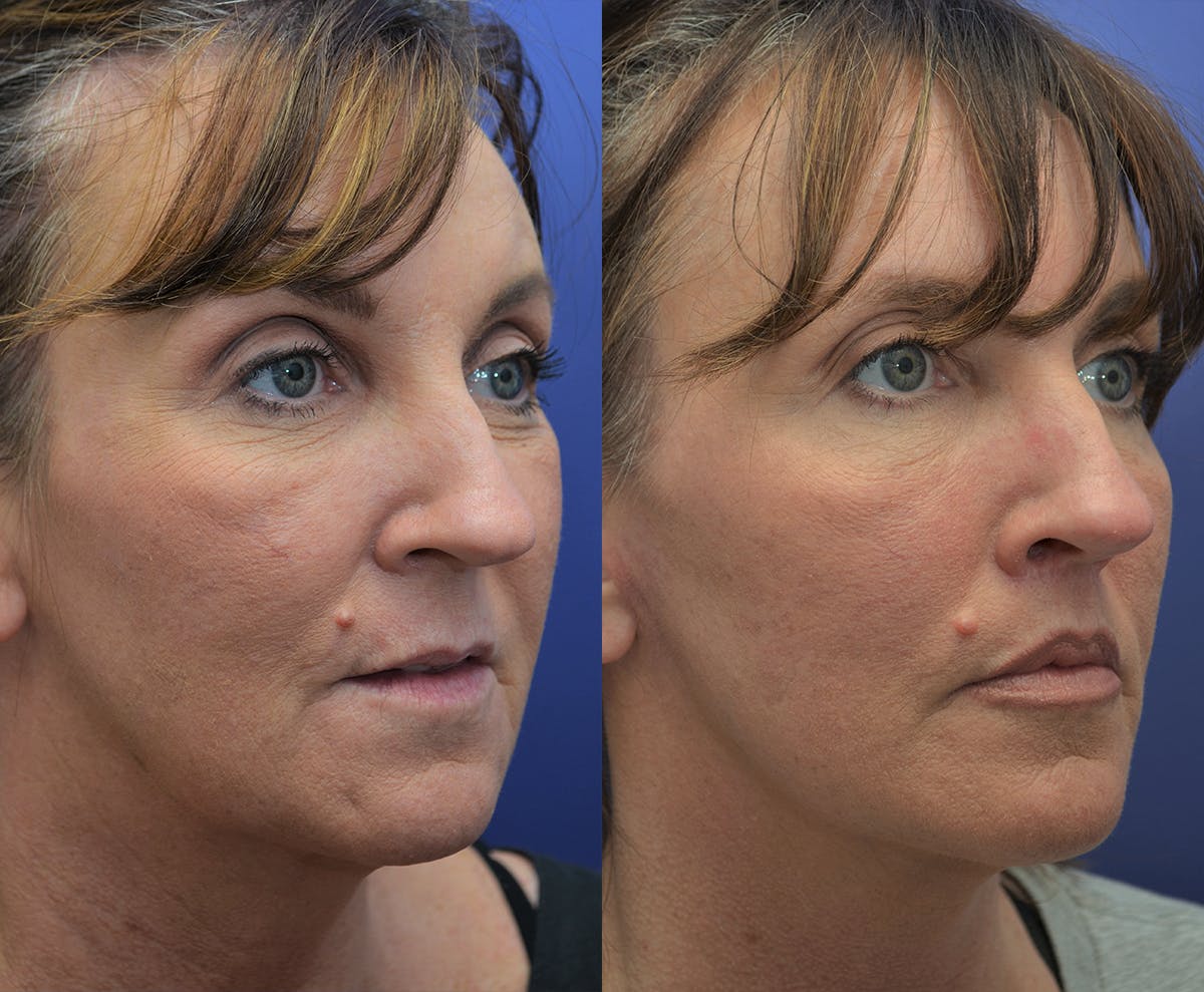 Deep Plane Facelift Before & After Gallery - Patient 121088 - Image 3