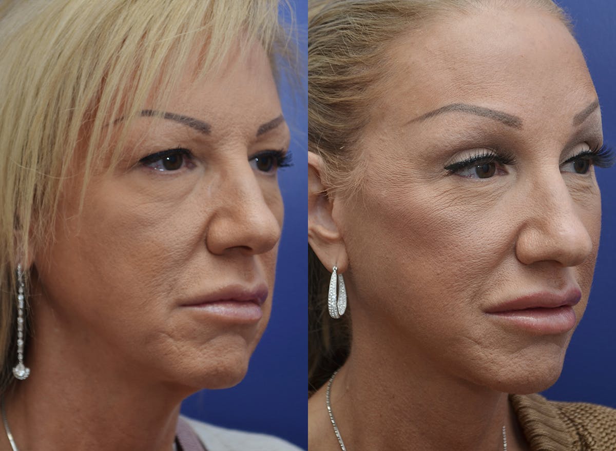 Deep Plane Facelift Before & After Gallery - Patient 194006 - Image 3