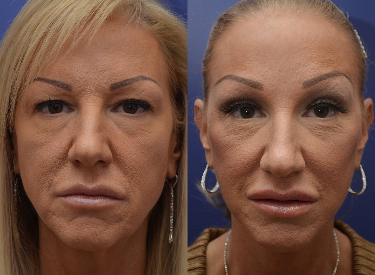 Deep Plane Facelift Before & After Gallery - Patient 194006 - Image 1