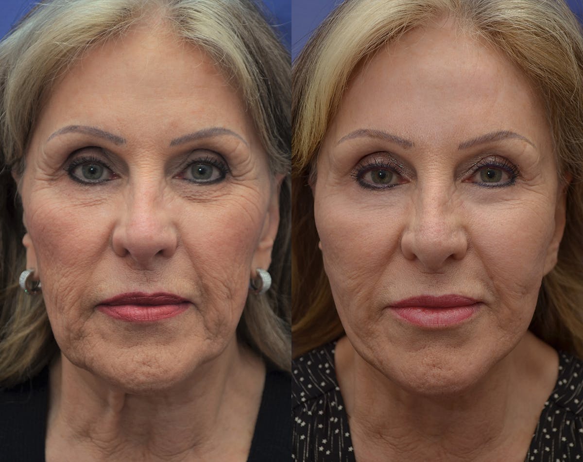 CO2 Laser Resurfacing Before & After Gallery - Patient 370441 - Image 1