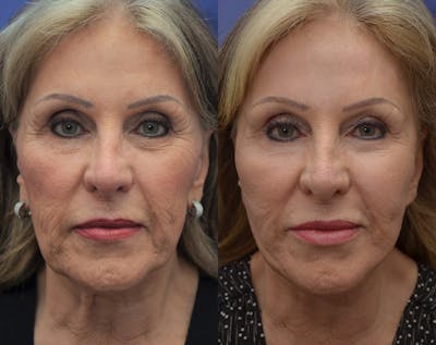 Full Facial Rejuvenation Before & After Gallery - Patient 270776 - Image 1