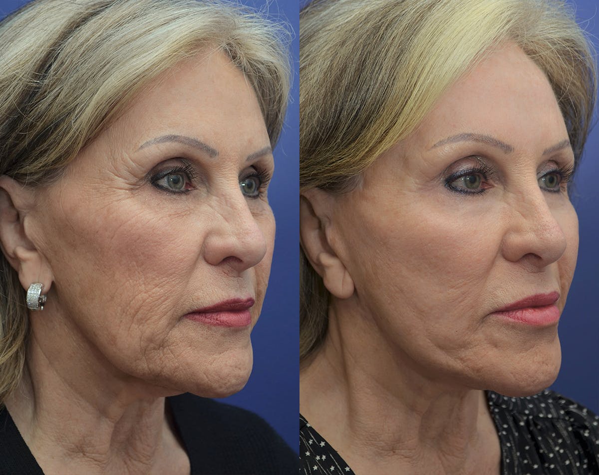 CO2 Laser Resurfacing Before & After Gallery - Patient 370441 - Image 3