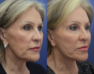 Full Facial Rejuvenation Before & After Gallery - Patient 270776 - Image 2