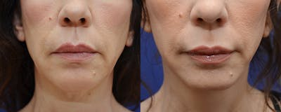 Full Facial Rejuvenation Before & After Gallery - Patient 285114 - Image 1