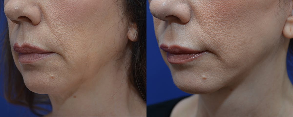 Deep Plane Facelift Before & After Gallery - Patient 358730 - Image 2