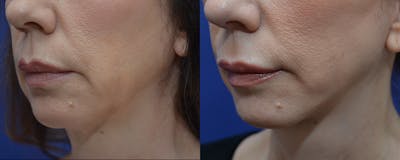 Full Facial Rejuvenation Before & After Gallery - Patient 285114 - Image 2