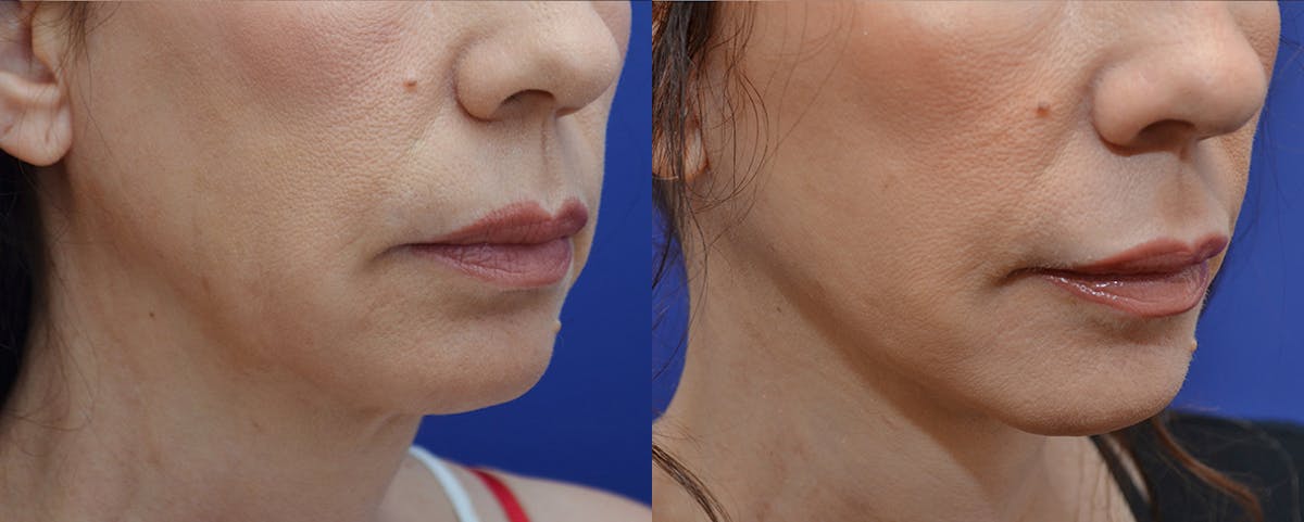 Deep Plane Facelift Before & After Gallery - Patient 358730 - Image 3