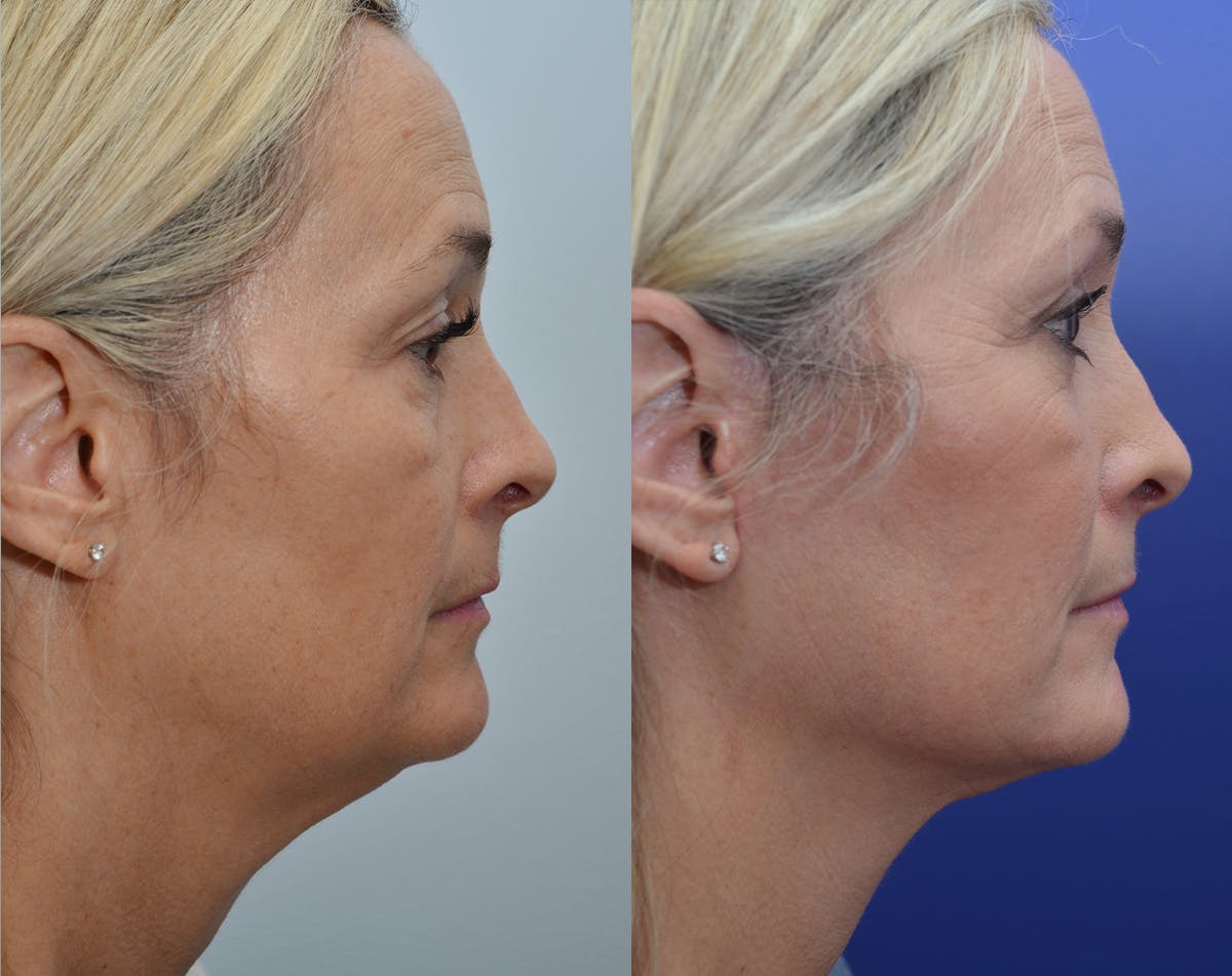 Deep Plane Facelift Before & After Gallery - Patient 162080 - Image 2
