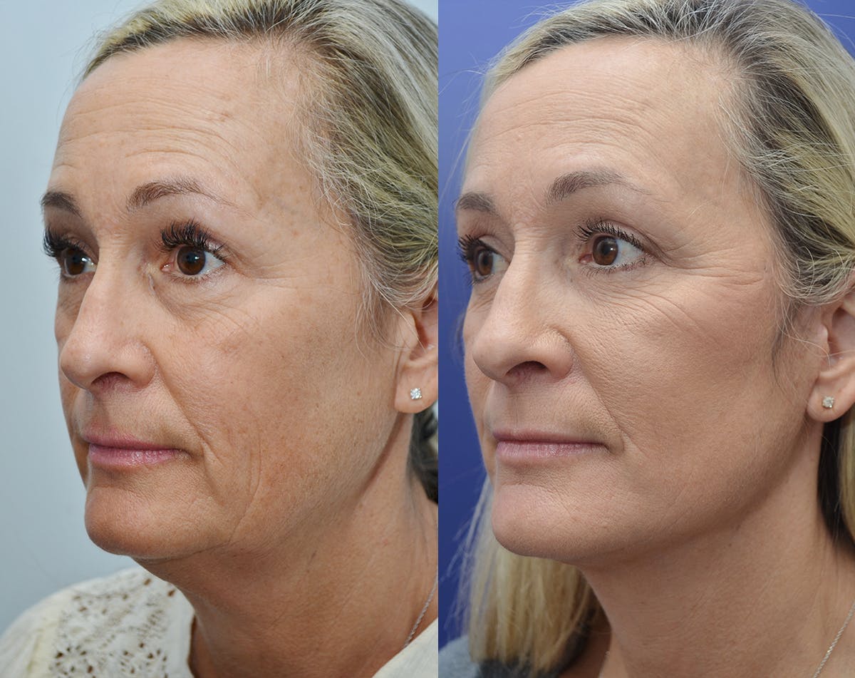 Deep Plane Facelift Before & After Gallery - Patient 162080 - Image 4