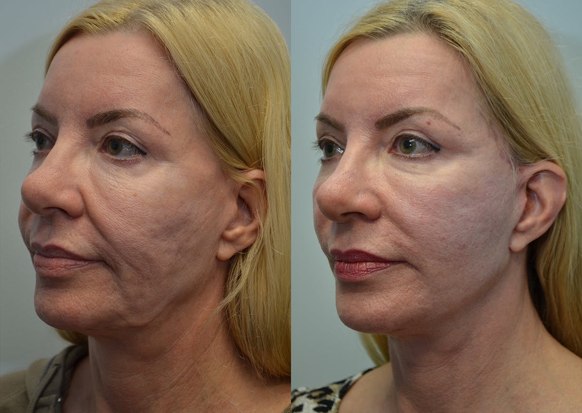 Deep Plane Facelift Before & After Gallery - Patient 377123 - Image 2