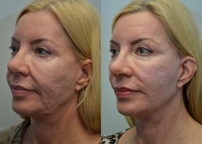 Full Facial Rejuvenation Before & After Gallery - Patient 916033 - Image 2