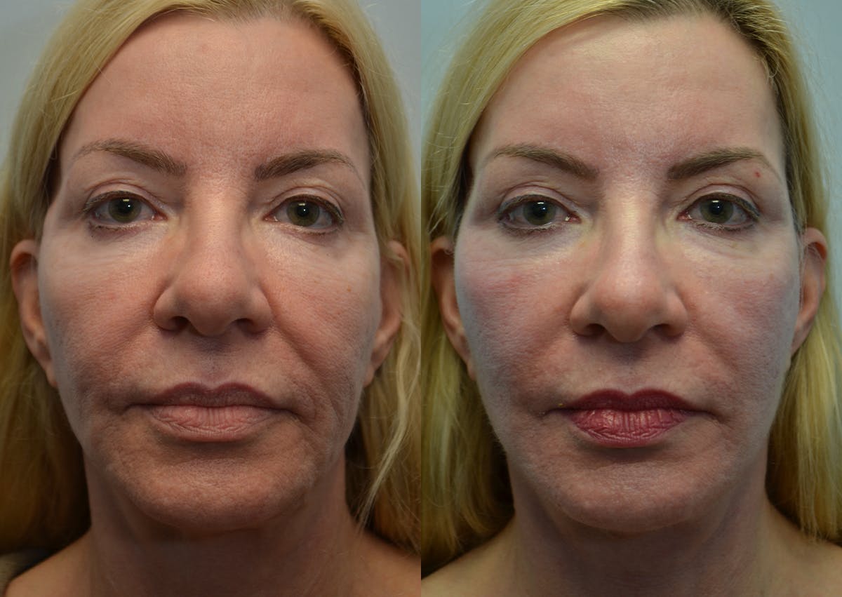Deep Plane Facelift Before & After Gallery - Patient 377123 - Image 1