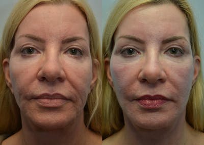 Full Facial Rejuvenation Before & After Gallery - Patient 916033 - Image 1