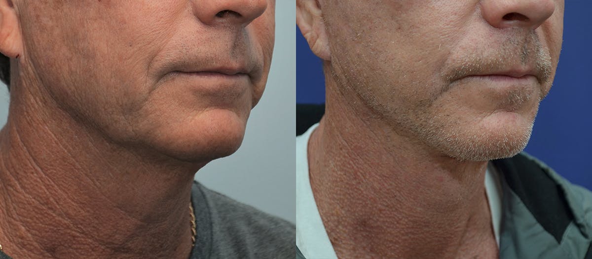 Full Facial Rejuvenation Before & After Gallery - Patient 132044 - Image 1
