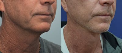 Full Facial Rejuvenation Before & After Gallery - Patient 132044 - Image 1