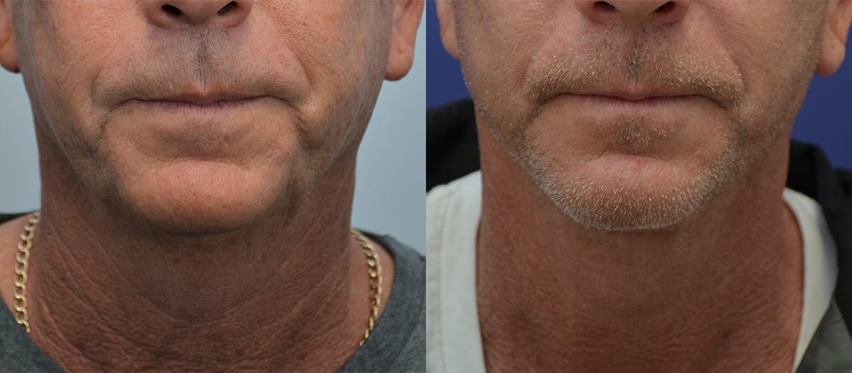Full Facial Rejuvenation Before & After Gallery - Patient 132044 - Image 3