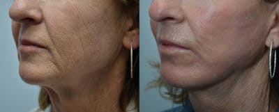 Full Facial Rejuvenation Before & After Gallery - Patient 293739 - Image 1