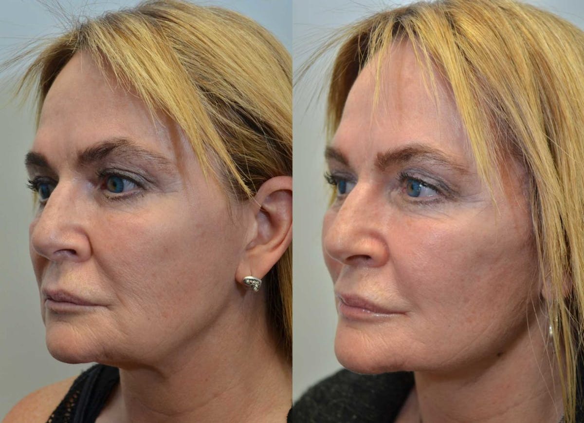 Full Facial Rejuvenation Before & After Gallery - Patient 386075 - Image 2