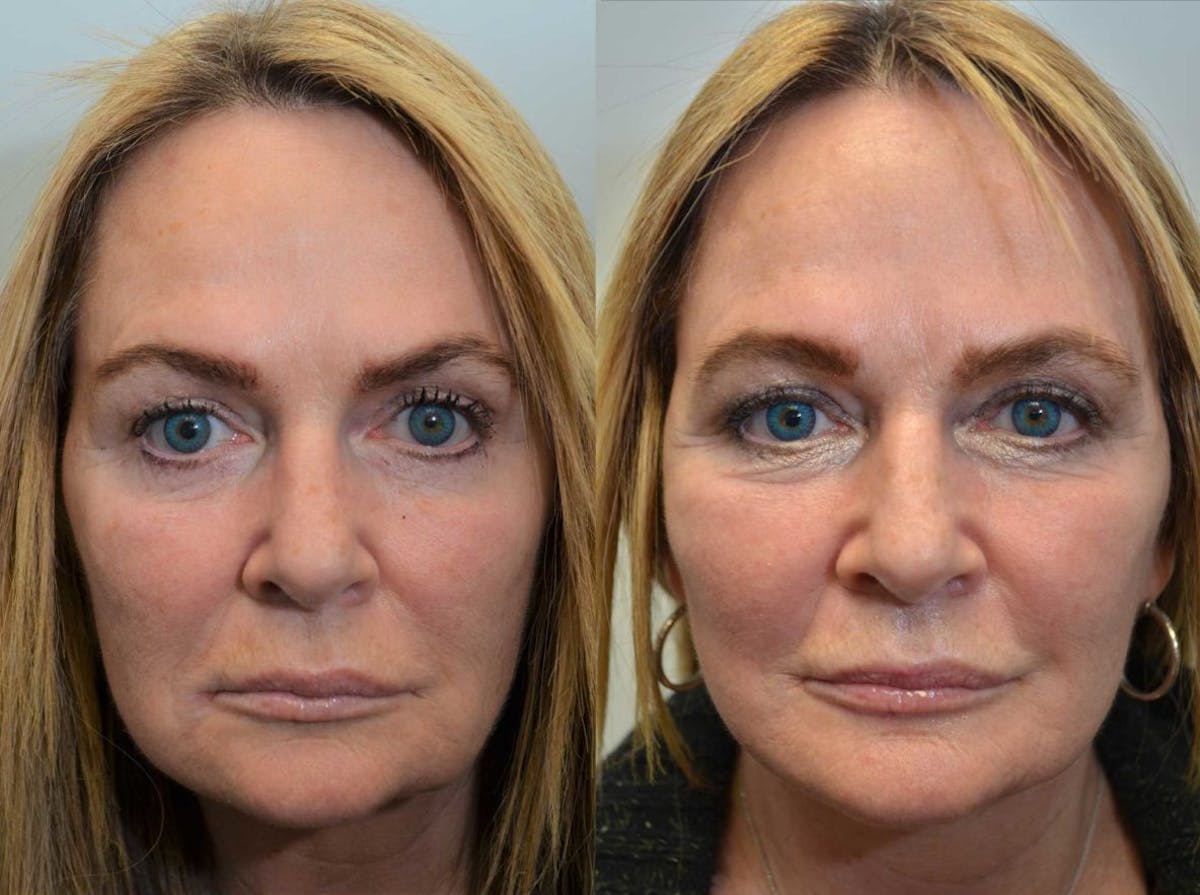 Full Facial Rejuvenation Before & After Gallery - Patient 386075 - Image 1