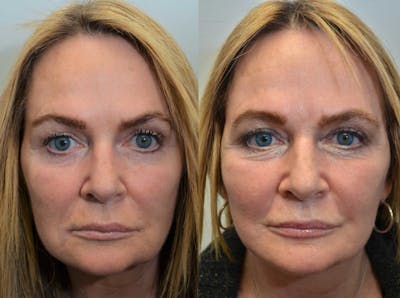 Full Facial Rejuvenation Before & After Gallery - Patient 386075 - Image 1