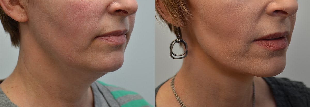 Deep Plane Facelift Before & After Gallery - Patient 205380 - Image 1