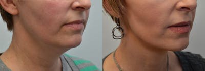 Full Facial Rejuvenation Before & After Gallery - Patient 108341 - Image 1