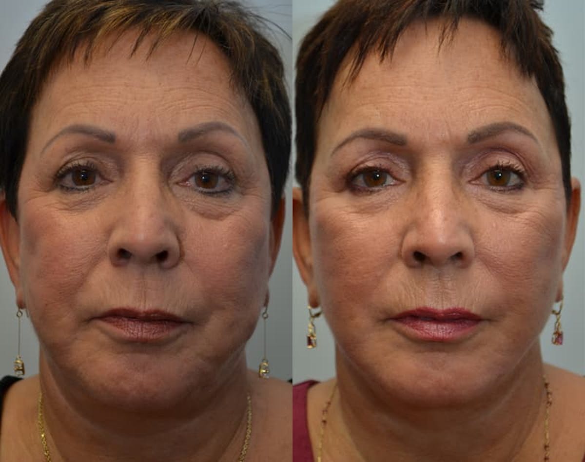 Deep Plane Facelift Before & After Gallery - Patient 783545 - Image 1