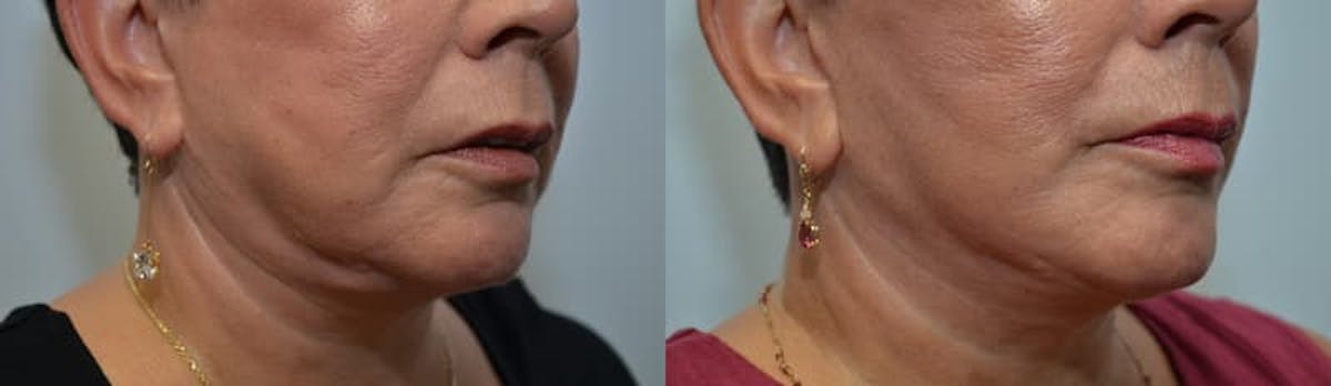 Deep Plane Facelift Before & After Gallery - Patient 783545 - Image 2