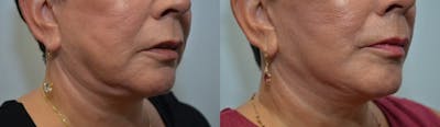 Full Facial Rejuvenation Before & After Gallery - Patient 298959 - Image 2