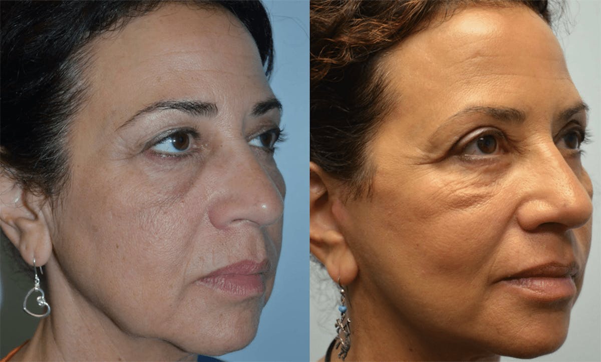 Deep Plane Facelift Before & After Gallery - Patient 568280 - Image 1