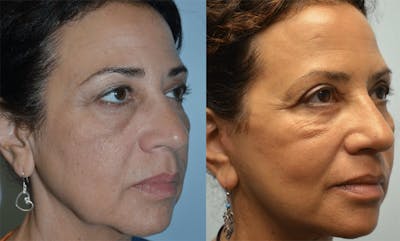 Full Facial Rejuvenation Before & After Gallery - Patient 250455 - Image 1