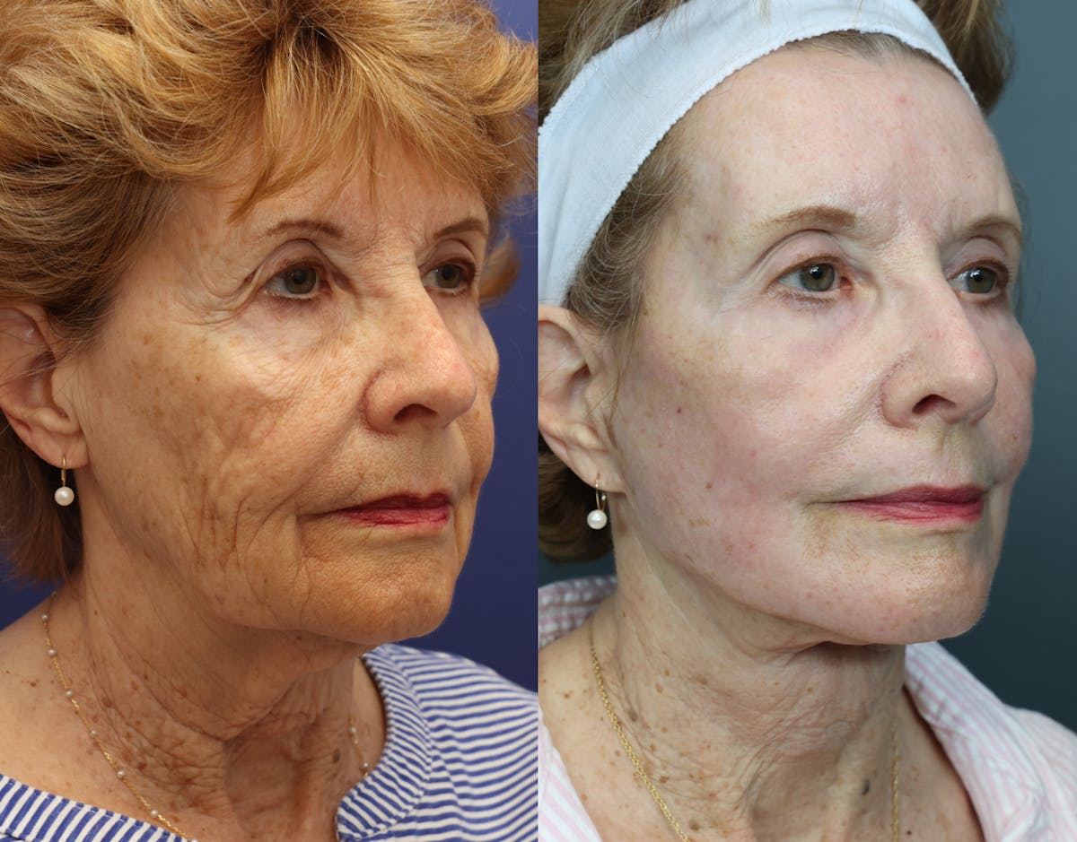 Deep Plane Neck Lift Before & After Gallery - Patient 237976 - Image 1