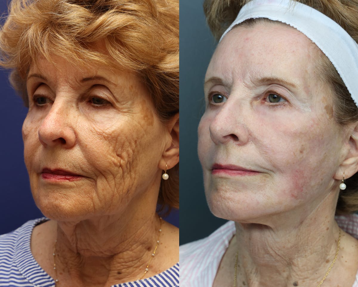 Deep Plane Neck Lift Before & After Gallery - Patient 237976 - Image 3