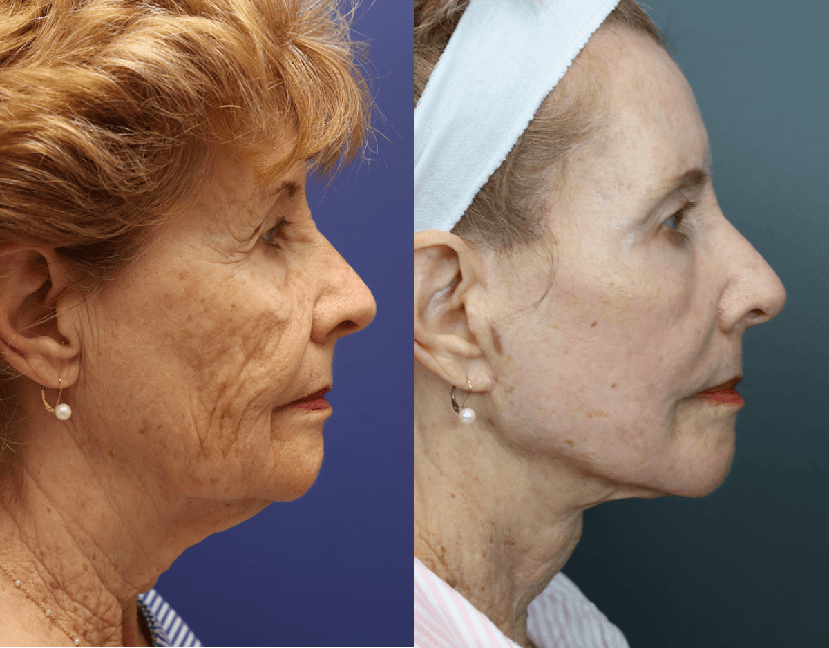 Deep Plane Neck Lift Before & After Gallery - Patient 237976 - Image 4