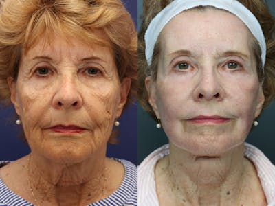 Full Facial Rejuvenation Before & After Gallery - Patient 418363 - Image 1