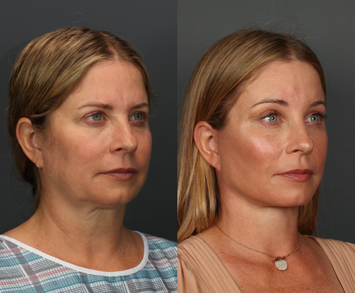 Deep Plane Neck Lift Before & After Gallery - Patient 340248 - Image 2