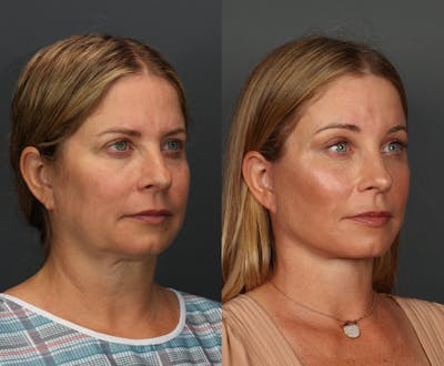 Full Facial Rejuvenation Before & After Gallery - Patient 261839 - Image 2