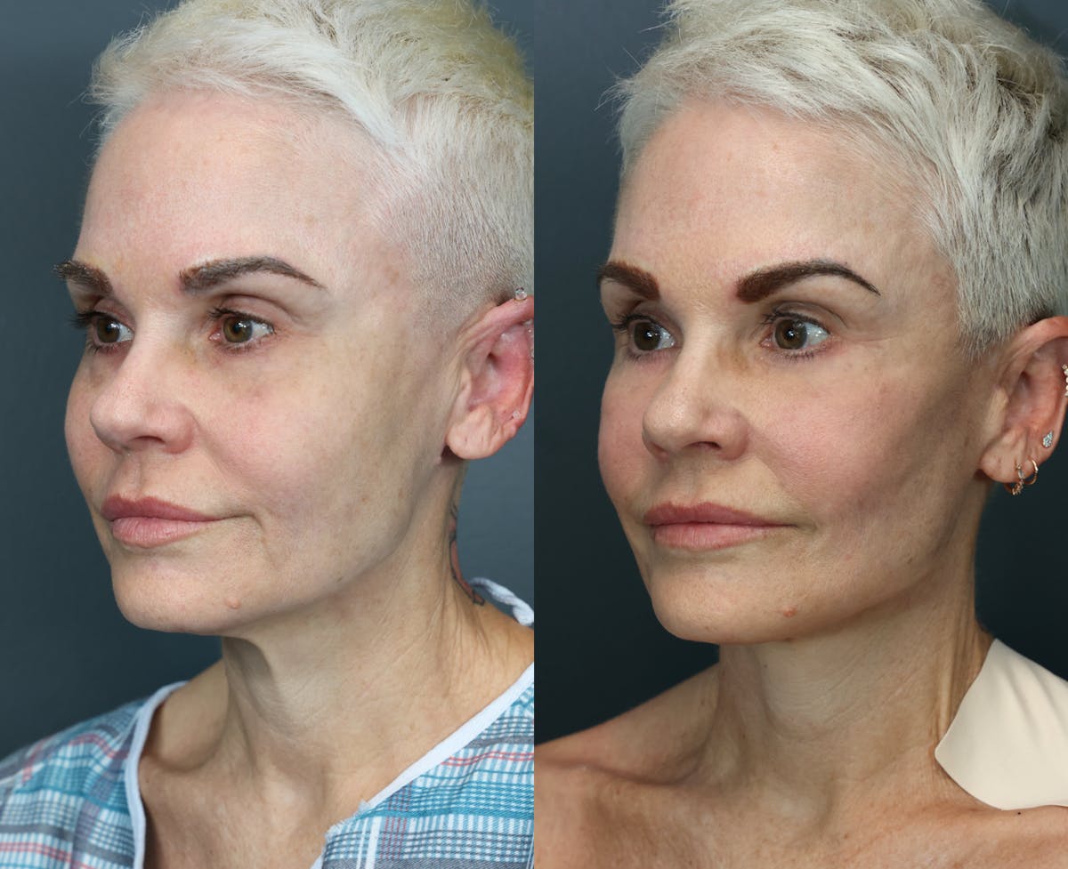 Eyelid Surgery Before & After Gallery - Patient 150936 - Image 5
