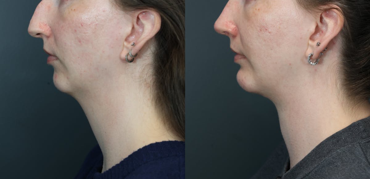 Deep Plane Neck Lift Before & After Gallery - Patient 233994 - Image 1