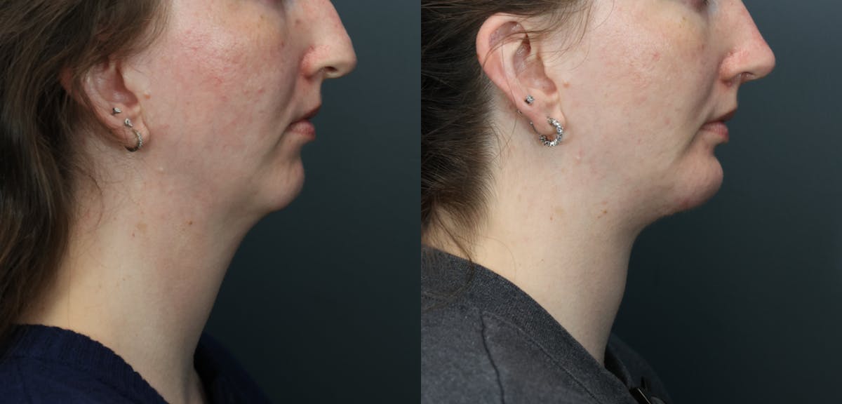 Deep Plane Neck Lift Before & After Gallery - Patient 233994 - Image 2