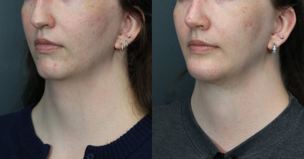 Deep Plane Neck Lift Before & After Gallery - Patient 233994 - Image 3