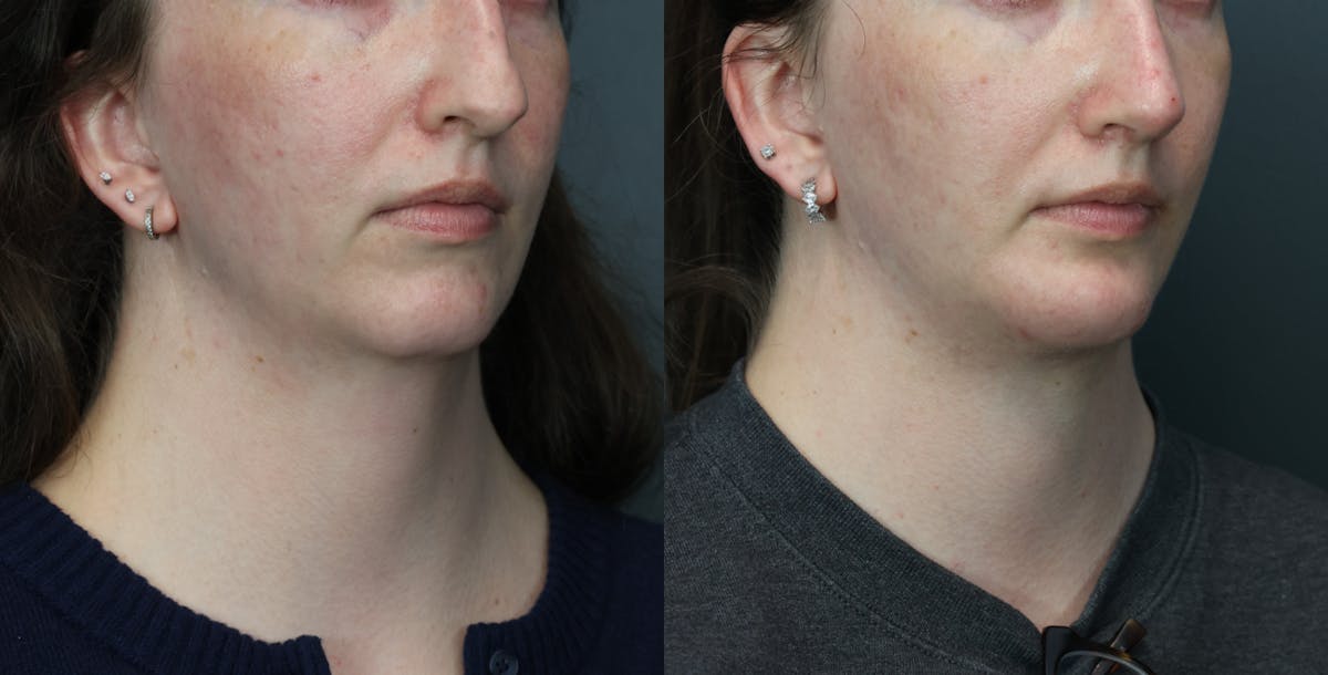 Deep Plane Neck Lift Before & After Gallery - Patient 233994 - Image 4