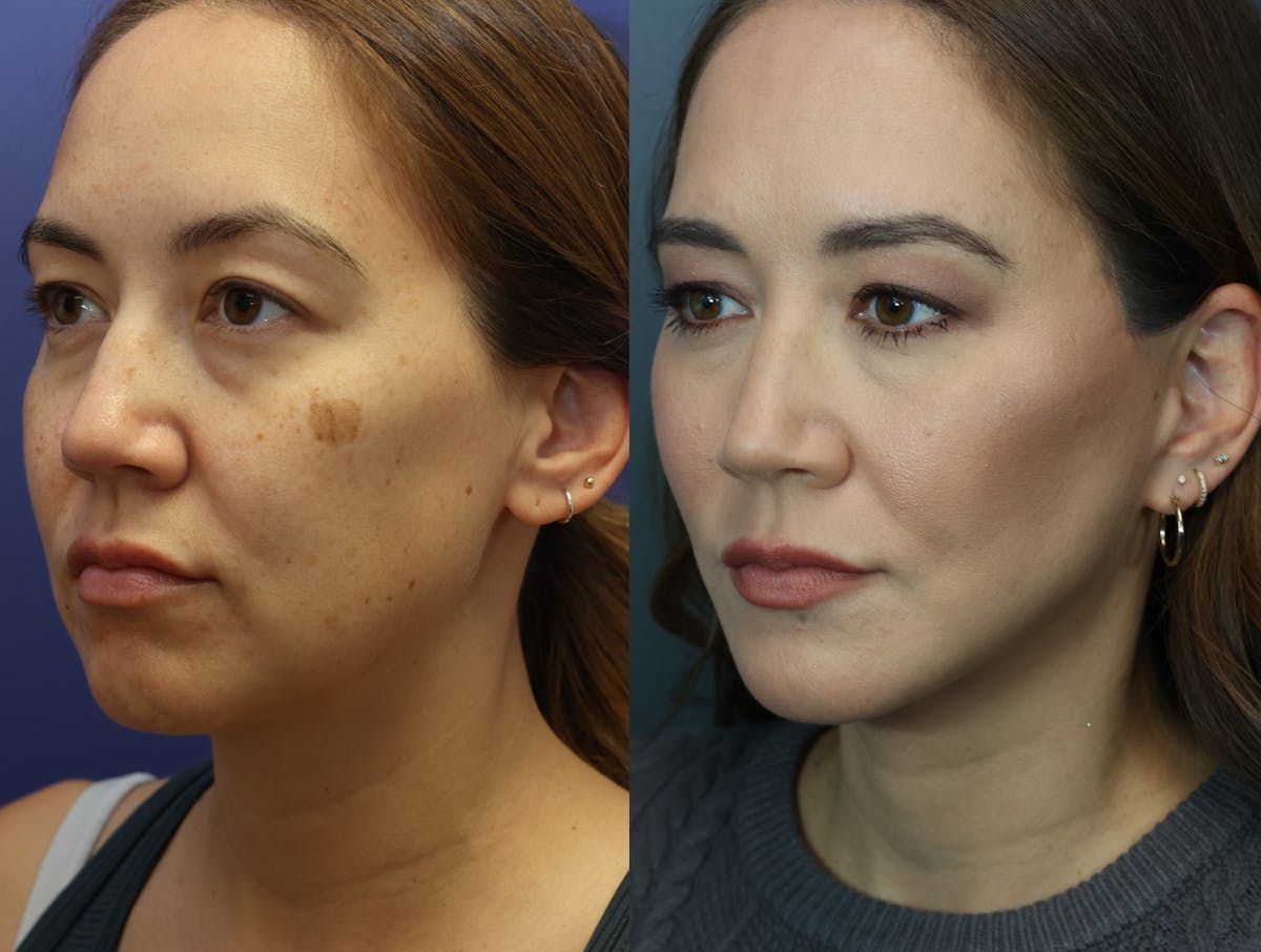 Deep Plane Neck Lift Before & After Gallery - Patient 113739 - Image 2