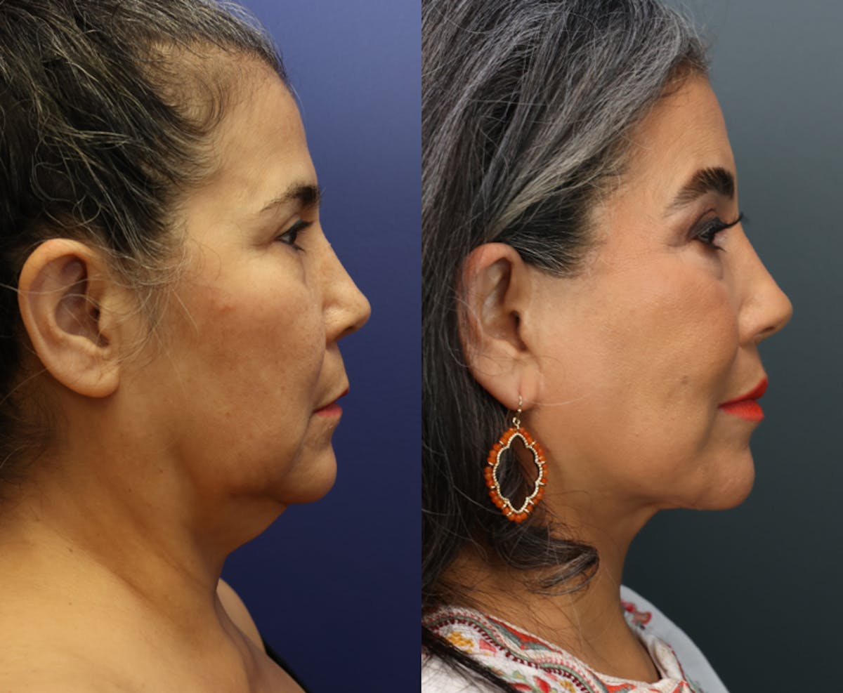 Deep Plane Neck Lift Before & After Gallery - Patient 258794 - Image 3